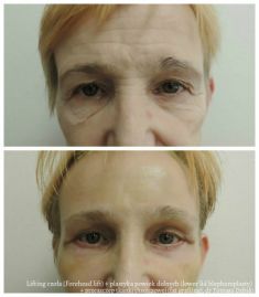 Lifting czoła (Forehead lift) - Zdjęcie przed - dr n. med. Tomasz Dębski