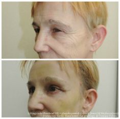 Lifting czoła (Forehead lift) - Zdjęcie przed - dr n. med. Tomasz Dębski