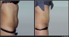 Abdominoplasty (Tummy Tucks) - Photo before - Dr. Lucian Fodor PhD