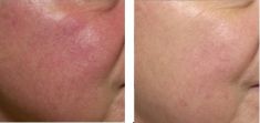 Spider veins laser removal (redness, birh marks) - Photo before - Bieńkowscy Clinic®