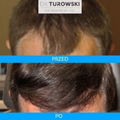 Hair Transplant - Photo before - Dr Turowski Hair Restoration Clinic