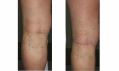 Sclerotization of varicose veins - Photo before - ARS ESTETICA – Klinika Medycyny Estetycznej i Laseroterapii