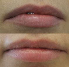Lip augmentation - cheiloplasty - Photo before - ARS ESTETICA – Klinika Medycyny Estetycznej i Laseroterapii