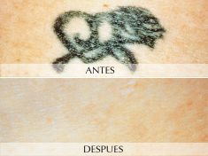 Eliminacion de tatuajes - Foto Antes de - Clínica Planas