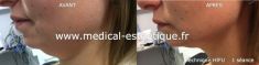 HIFU thérapie (lifting médical) - Cliché avant - Dr AMAT - ????Greffe FUE 2.0 Medic Xpert