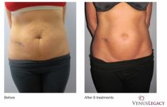 Radiofrekwencja (urzadzenie Aluma, Accent, TriPollar, Spa RF, Pelleve) - Zdjęcie przed - Bieńkowscy Clinic®