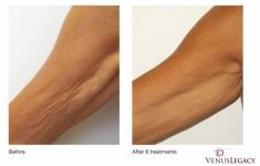 Radiofrekwencja (urzadzenie Aluma, Accent, TriPollar, Spa RF, Pelleve) - Zdjęcie przed - Bieńkowscy Clinic®