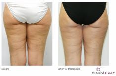 Radiofrekwencja (urzadzenie Aluma, Accent, TriPollar, Spa RF, Pelleve) - Zdjęcie przed - Bieńkowscy Clinic®