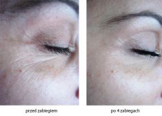 Radiofrekwencja (urzadzenie Aluma, Accent, TriPollar, Spa RF, Pelleve) - Zdjęcie przed - Bieńkowscy Clinic®