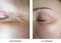 Radiofrekwencja (urzadzenie Aluma, Accent, TriPollar, Spa RF, Pelleve) - Zdjęcie przed - Bieńkowscy Clinic®