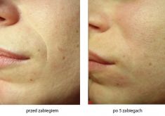 Radiofrekwencja (urzadzenie Aluma, Accent, TriPollar, Spa RF, Pelleve) - Zdjęcie przed - Bieńkowscy Clinic®