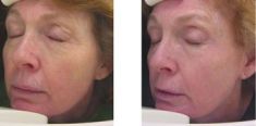 Radiofrequency Rejuvenation (Aluma, accent, TriPollar, Spa RF device, Re-Age) - Photo before - Klinika Laser Esthetic