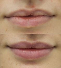 Lip augmentation - cheiloplasty - Photo before - ARS ESTETICA – Klinika Medycyny Estetycznej i Laseroterapii
