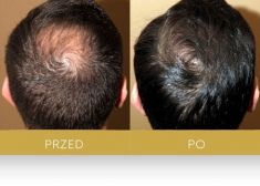 Hair Transplant - Photo before - Dr Turowski Hair Restoration Clinic