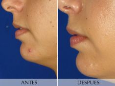 Mentoplastia - Foto Antes de - Clínica Planas