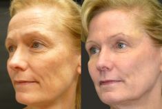 Botulinum toxin - Wrinkle Removal - Photo before - Dr Fadi Nukta