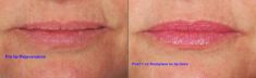 Dermal fillers - Photo before - Marc J. Salzman, MD.