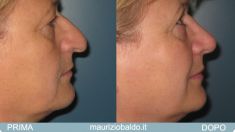 Rinoplastica - Foto del prima - Dott. Maurizio Baldo M.D.