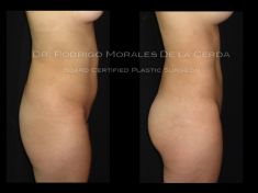 Laser Liposuction - CoolLipo - Photo before - Dr. Rodrigo Morales De la Cerda