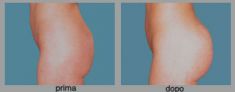 Operazioni di chirurgia plastica glutei - Foto del prima - Dott. Luca Leva Chirurgo Plastico