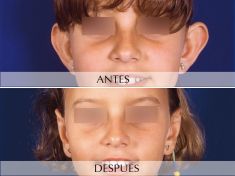 Otoplastia - Foto Antes de - Clínica Planas