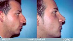 Rinoplastica - Foto del prima - Dott. Maurizio Baldo M.D.