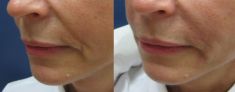 Injekční výplně - fotka před - MUDr. Evžen Trupar Ph.D.