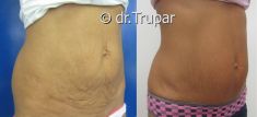 Abdominoplastika (Operace břicha) - fotka před - MUDr. Evžen Trupar Ph.D.