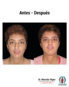 Cirugía de la nariz (Rinoplastia) - Foto Antes de - Dra. Marcela Yépez Intriago