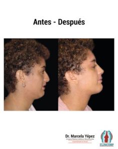 Cirugía de la nariz (Rinoplastia) - Foto Antes de - Dra. Marcela Yépez Intriago