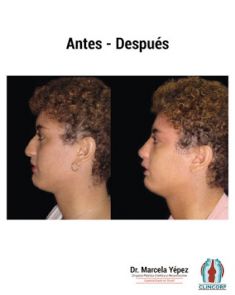Cirugía de la nariz (Rinoplastia) - Foto Antes de - Dra. Marcela Yépez Intriago