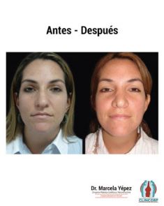 Cirugía de la nariz (Rinoplastia) - Foto Antes de - Dra. Marcela Yépez Intriago