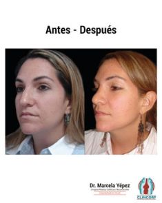 Cirugía de la nariz (Rinoplastia) - Foto Antes de - Dra. Marcela Yépez Intriago