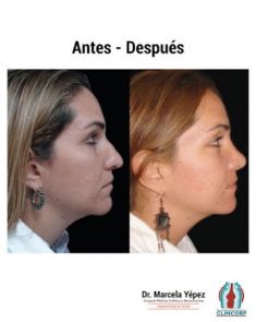 Cirugía de la nariz (Rinoplastia) - Foto Antes de - Dra. Marcela Yépez Intriago