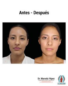 Cirugía de la nariz (Rinoplastia) - Foto Antes de - Dra. Marcela Yépez Intriago