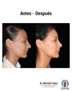 Cirugía de la nariz (Rinoplastia) - Foto Antes de - Dra. Marcela Yépez Intriago