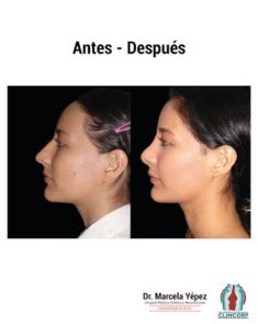 Cirugía de la nariz (Rinoplastia) - Foto Antes de - Dra. Marcela Yépez Intriago