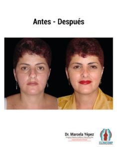 Cirugía de la nariz (Rinoplastia) - Foto Antes de - Dra. Marcela Yépez Intriago