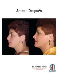 Cirugía de la nariz (Rinoplastia) - Foto Antes de - Dra. Marcela Yépez Intriago