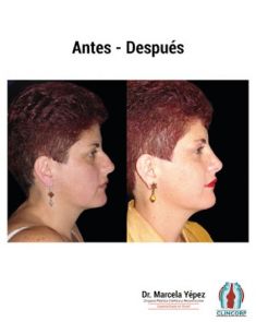 Cirugía de la nariz (Rinoplastia) - Foto Antes de - Dra. Marcela Yépez Intriago