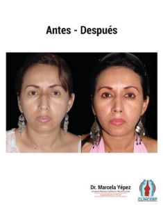 Cirugía de la nariz (Rinoplastia) - Foto Antes de - Dra. Marcela Yépez Intriago