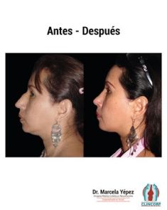 Cirugía de la nariz (Rinoplastia) - Foto Antes de - Dra. Marcela Yépez Intriago