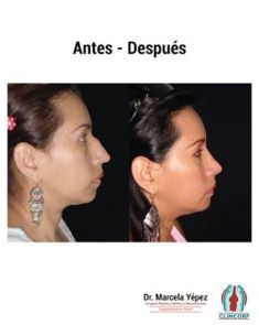 Cirugía de la nariz (Rinoplastia) - Foto Antes de - Dra. Marcela Yépez Intriago