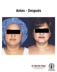 Liposucción de la papada - Foto Antes de - Dra. Marcela Yépez Intriago