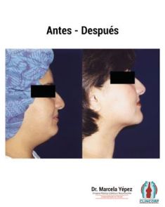 Liposucción de la papada - Foto Antes de - Dra. Marcela Yépez Intriago