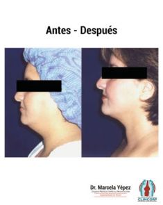 Liposucción de la papada - Foto Antes de - Dra. Marcela Yépez Intriago