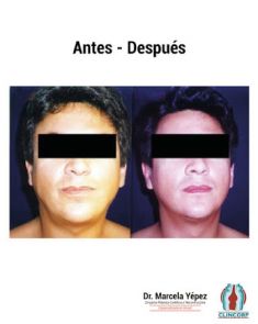 Liposucción de la papada - Foto Antes de - Dra. Marcela Yépez Intriago