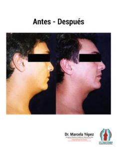 Liposucción de la papada - Foto Antes de - Dra. Marcela Yépez Intriago