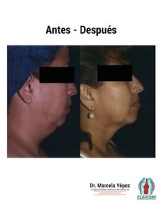 Liposucción de la papada - Foto Antes de - Dra. Marcela Yépez Intriago