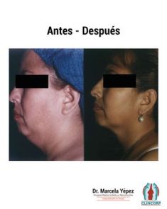 Liposucción de la papada - Foto Antes de - Dra. Marcela Yépez Intriago